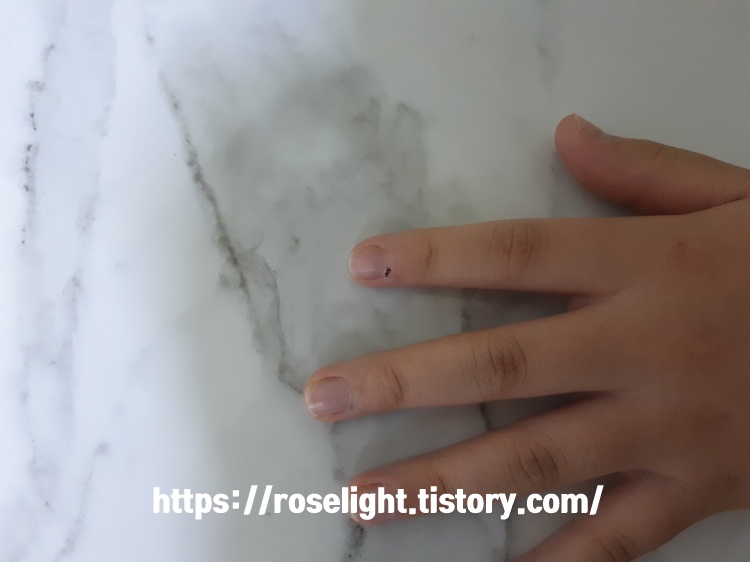 손가락사마귀-냉동치료-2주후-모습