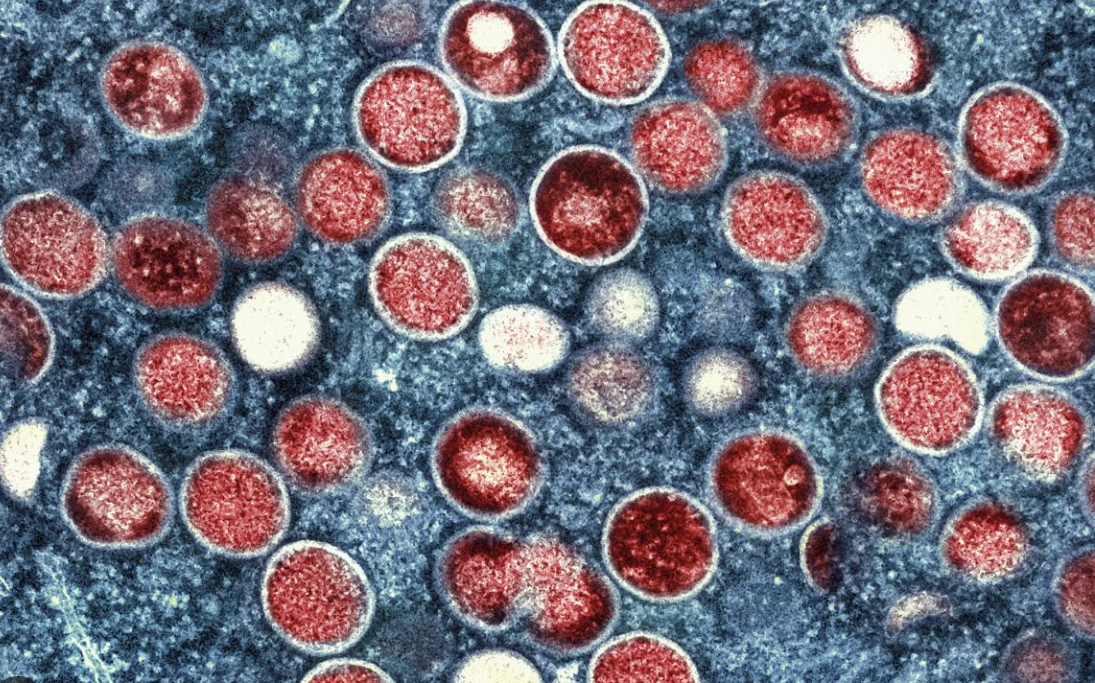 엠폭스 증상 감염경로