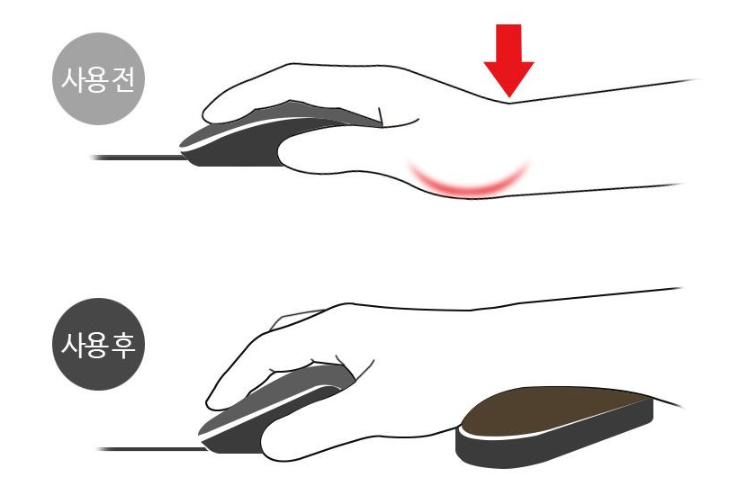 손목터널증후군