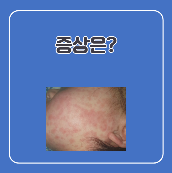 열꽃 두드러기 증상, 콜린성 두드러기 증상
