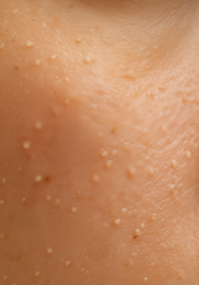 비립종 생기는 이유