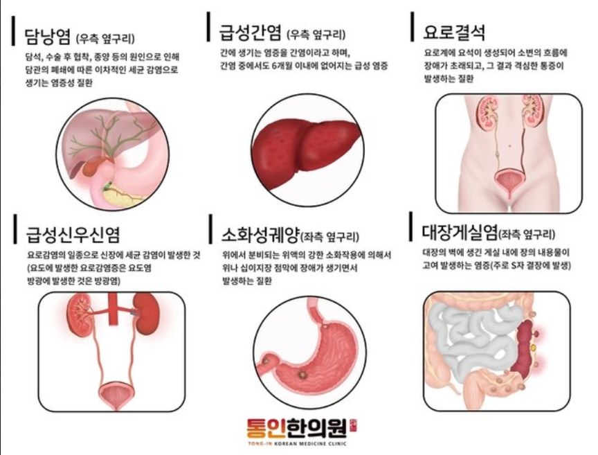 왼쪽 오른쪽 옆구리 통증 원인 5가지와 찌릿한 증상별 대처법 총정리