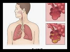 폐렴 예방접종 가격 시기