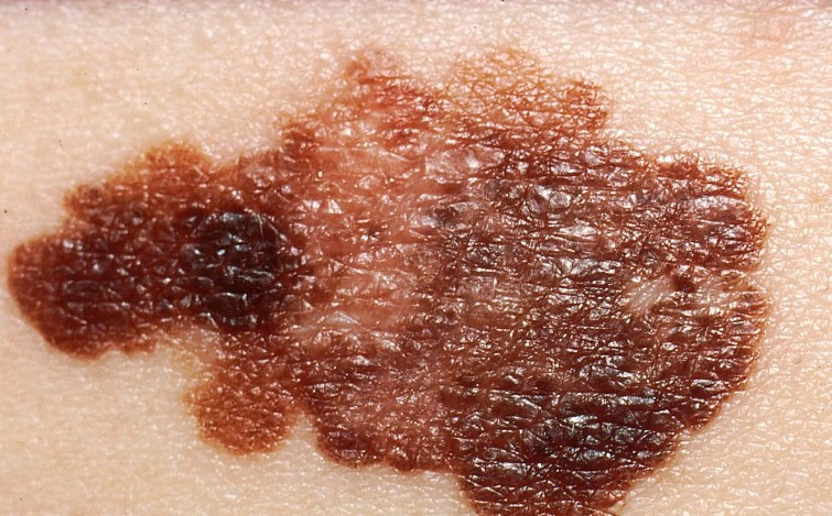 흑색종 피부암 초기 및 증상