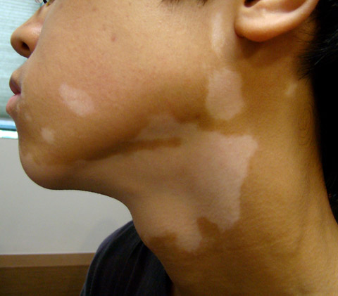 백반증-증상-유전성-진단-치료-명의-리스트