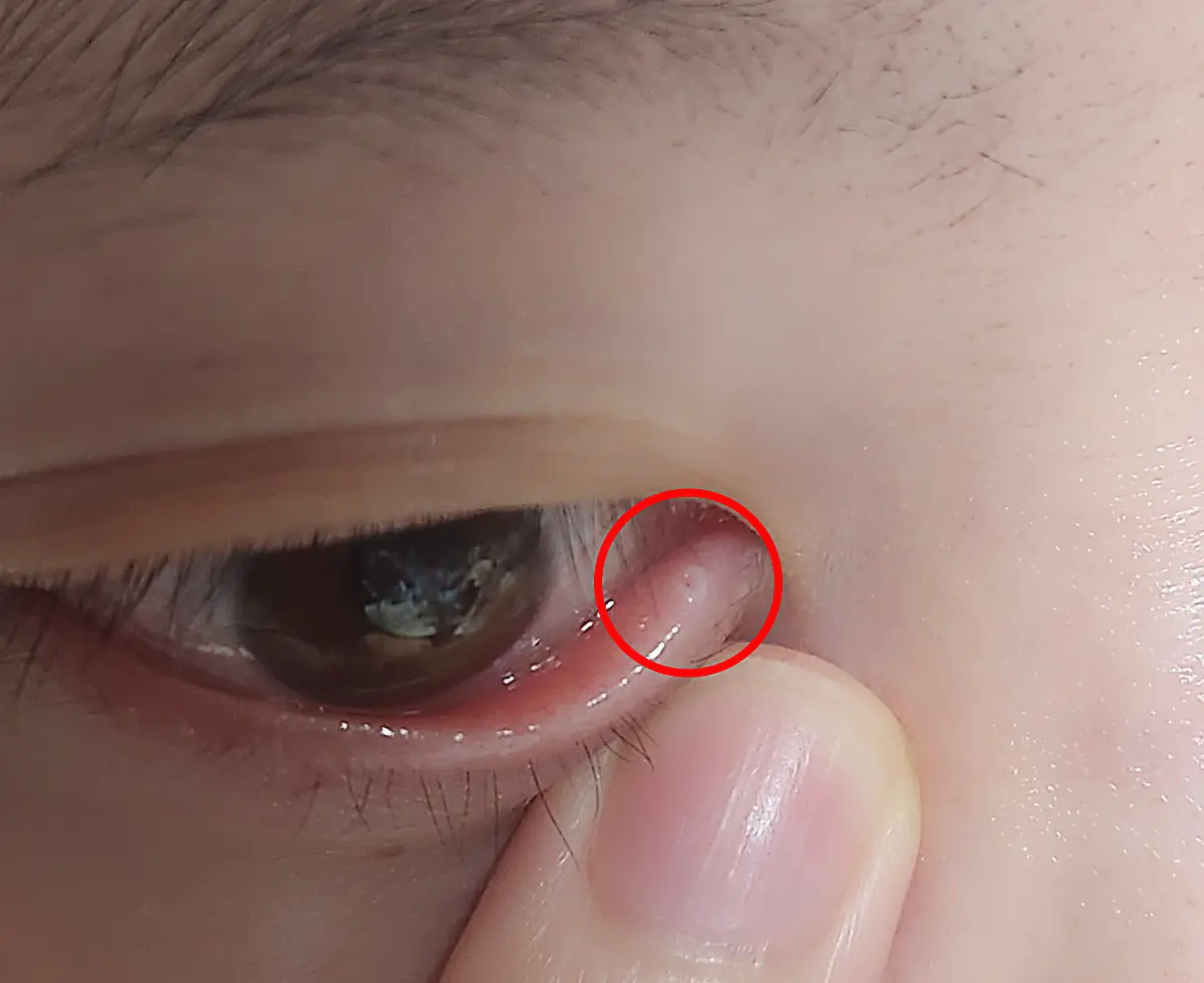 누점폐쇄술-누점-위치-눈꺼풀-아래-구멍