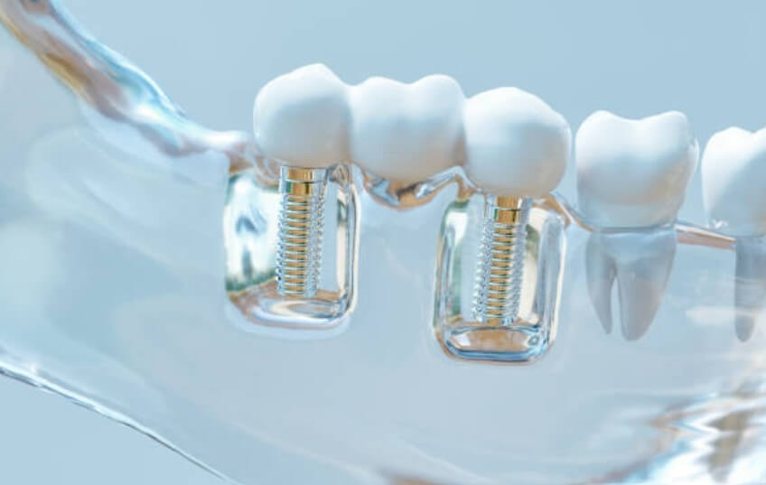 임플란트 시술기간