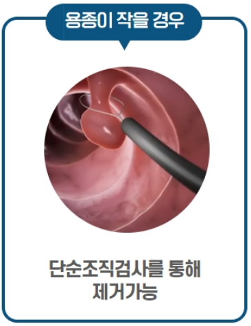 대장내시경-용종제거-선종제거-보험청구-방법안내