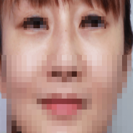 눈밑지방재배치 수술 후 여성의 모습