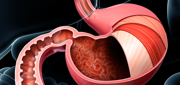 위식도역류질환 증상2