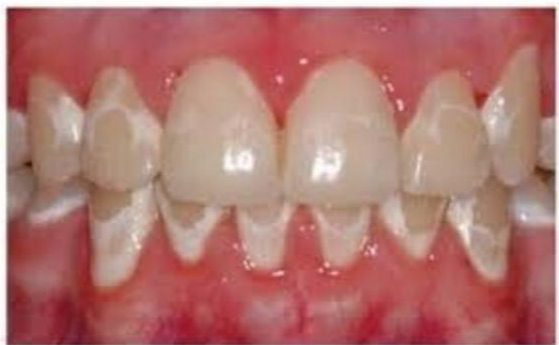 치아교정 부작용