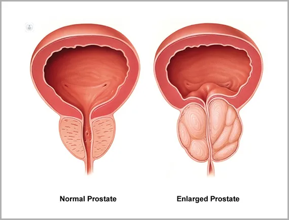 정상-전립선과-전립선암의-비교-이미지
