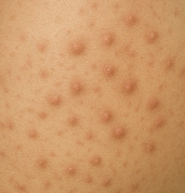 스테로이드 부작용