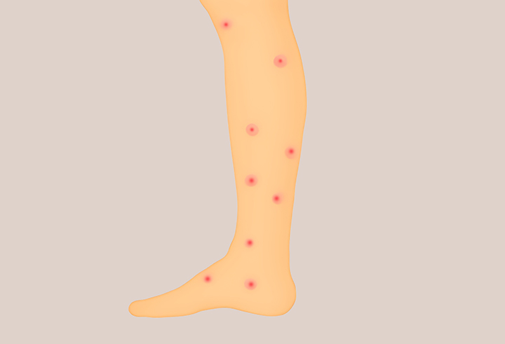 엠폭스-증상이-나타난-발