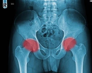 골반괴사의 진단 방법