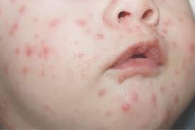 대상포진 가격알아보기