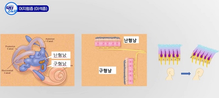 이석증 난형낭 구형낭