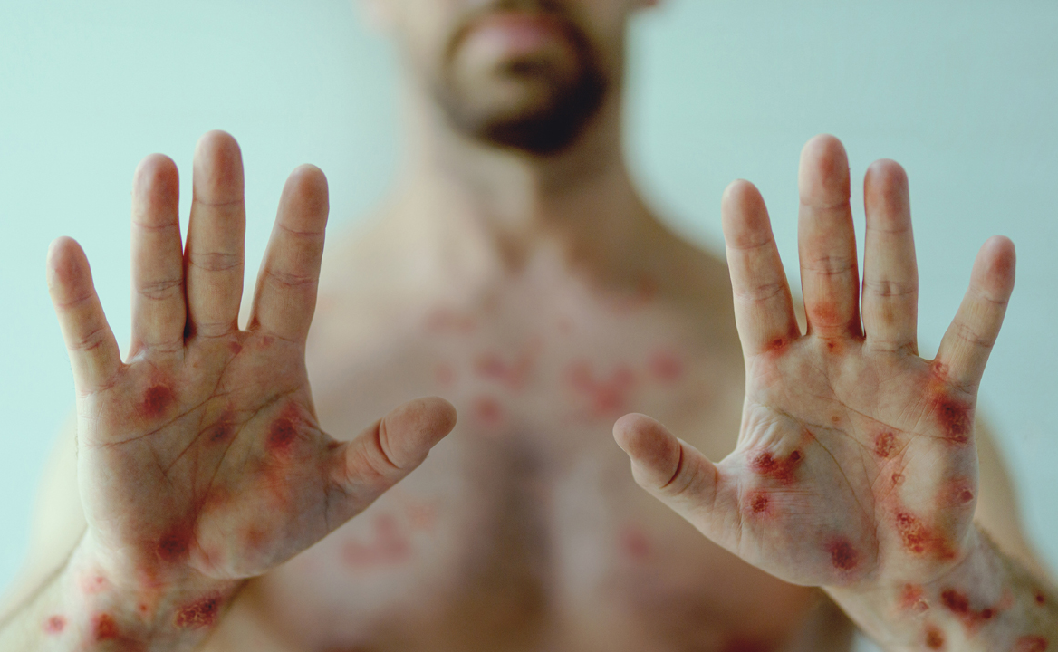 엠폭스 증상 발진