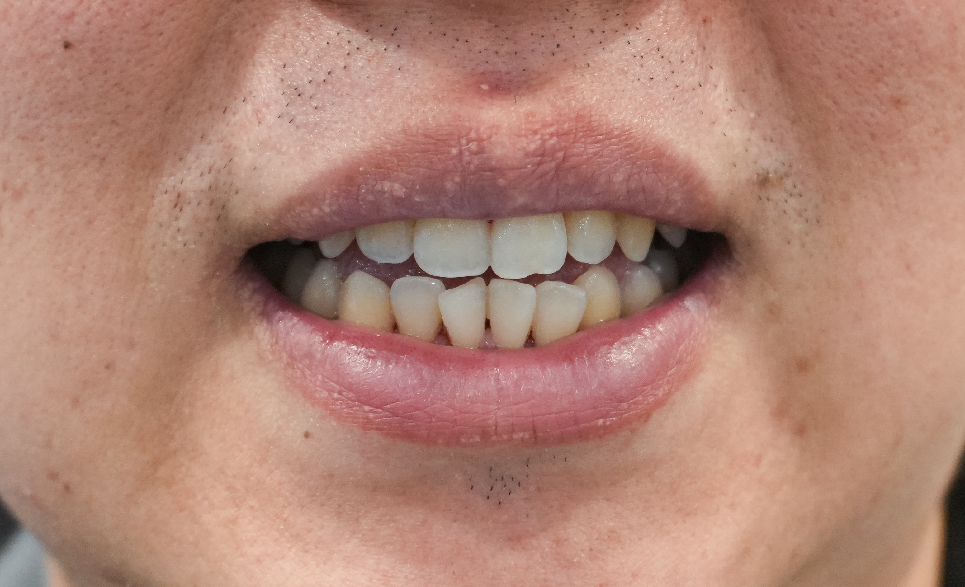 우리들치과 스케일링