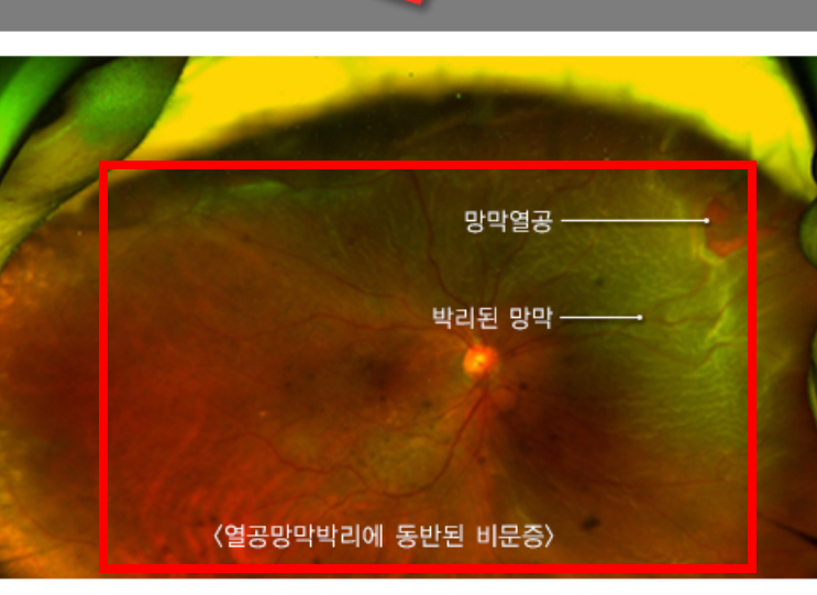 비문증 치료방법 알아보기