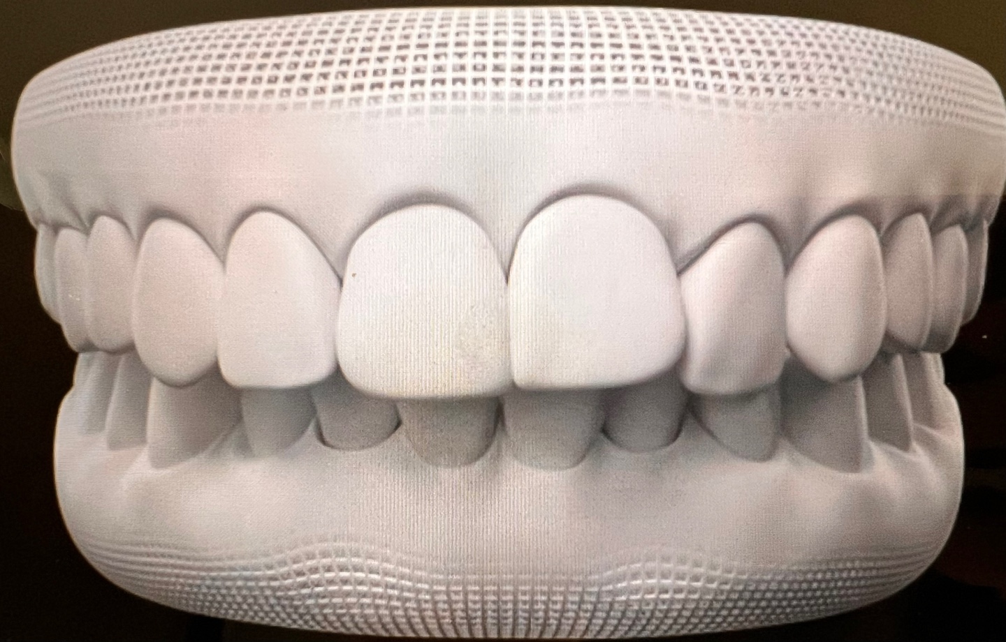 인비절라인 케이스, 윗니가 아랫니를 덮고있는 수직피개