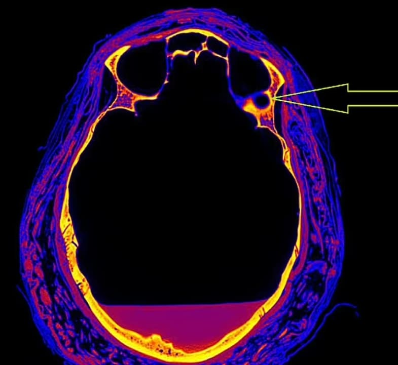 세계 최초 임신한 고대 이집트 미이라는 희귀 암으로 사망 VIDEO: Scans show an ancient mummy in Egypt was pregnant