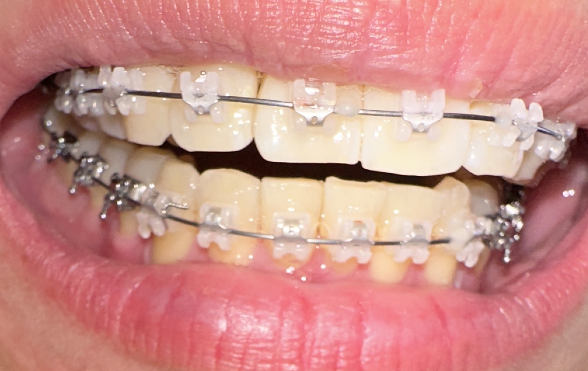 치아교정한지 82일차 된 앞면 사진