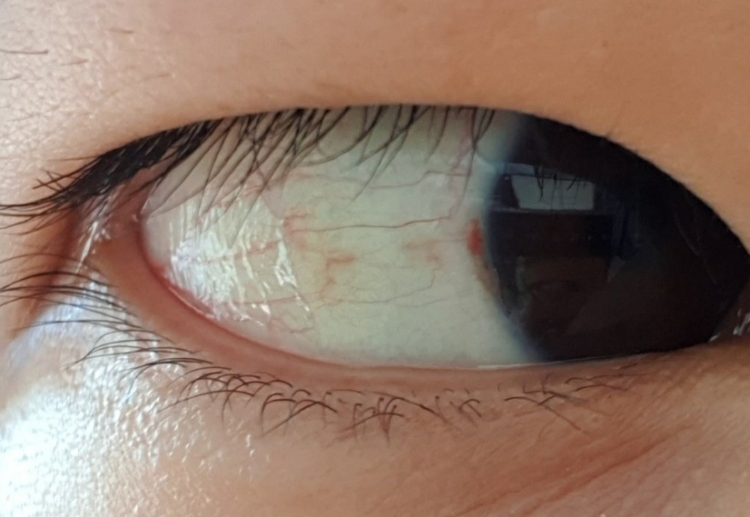 눈 흰자 물집 치료 후 12일째