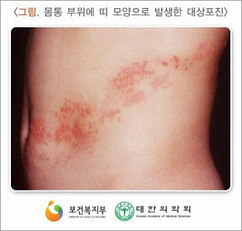 대상포진 초기증상