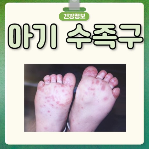 수족구병: 원인, 증상, 예방 및 관리 방법 총정리