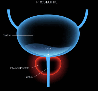 전립선 비대증 치료약