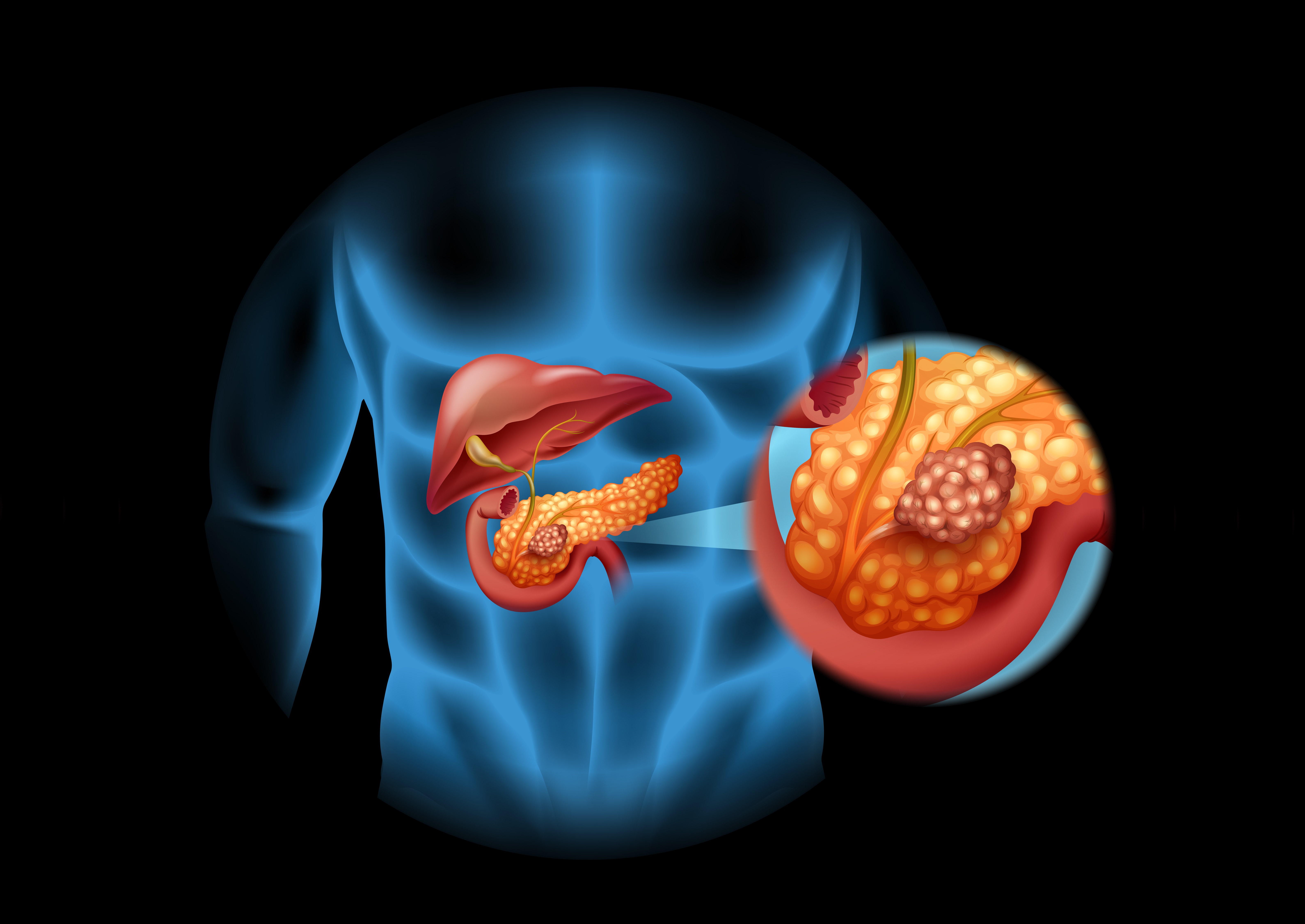 췌장암 초기증상 원인 치료