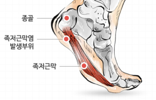 족저 근막염 치료법 알아보기 섬네일