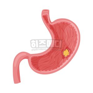 위내시경 전날 음식 금식시간