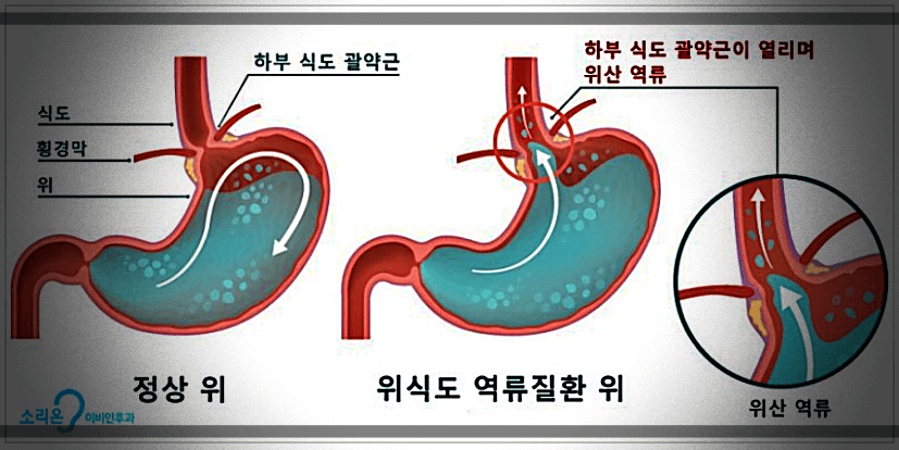 정상-위-및-위식도-역류질환-위-차이