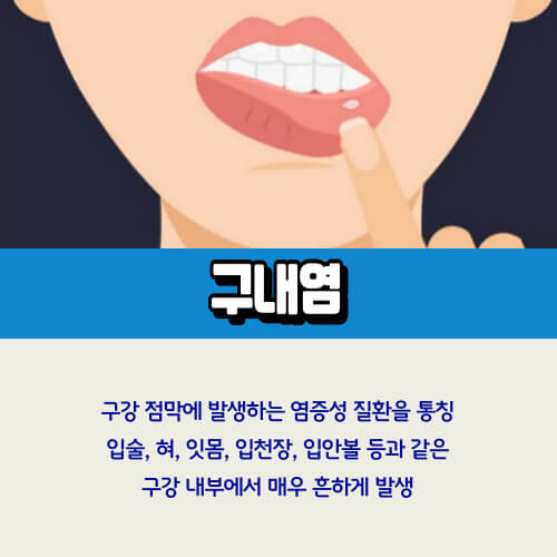 구내염