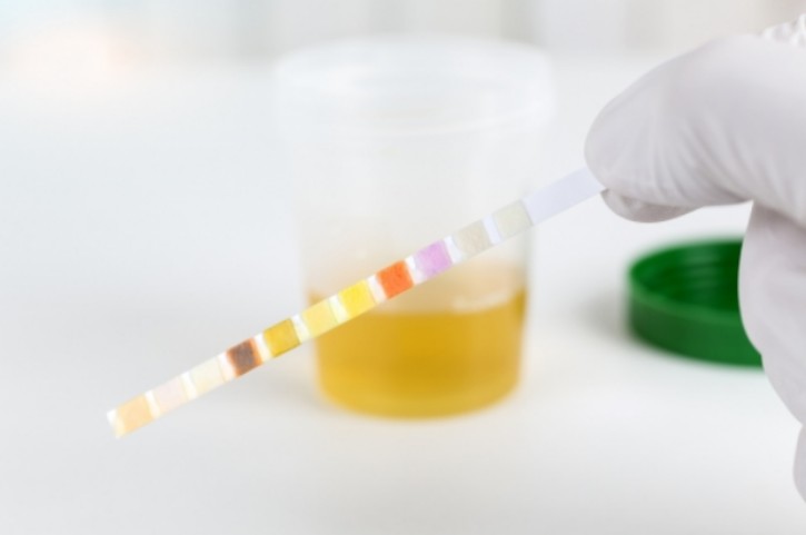 소변색깔이-적갈색-이라면