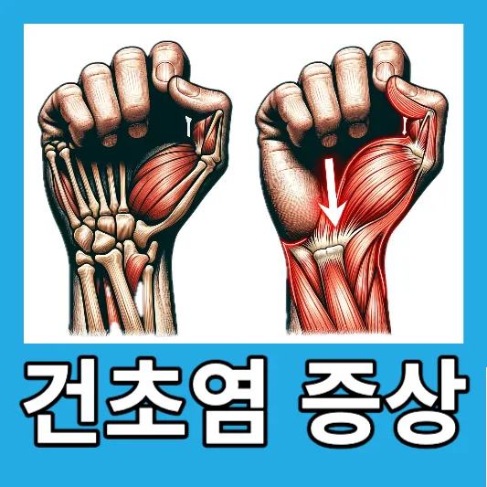 손목 건초염의 증상