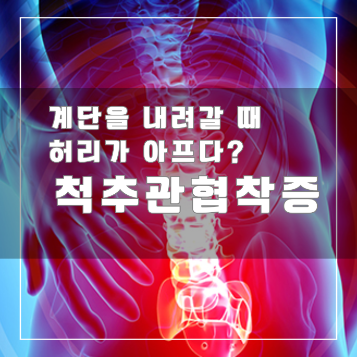 척추관협착증