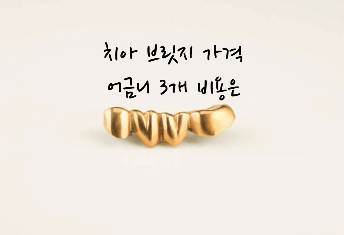 치아 브릿지 가격