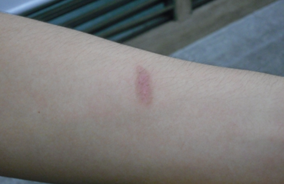 아기 화상 응급 처치 방법 및 치료법