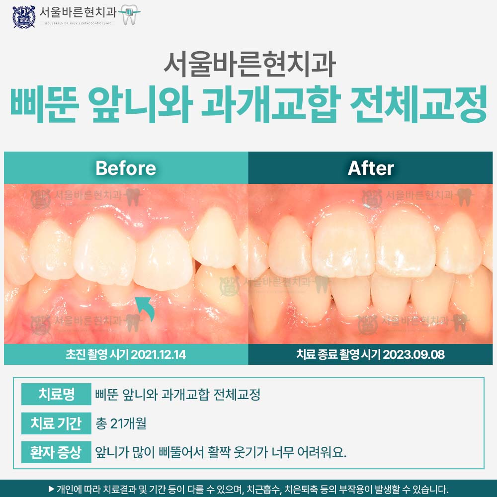 해운대치아교정