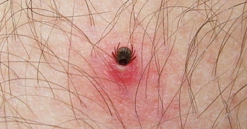 진드기 물린 자국