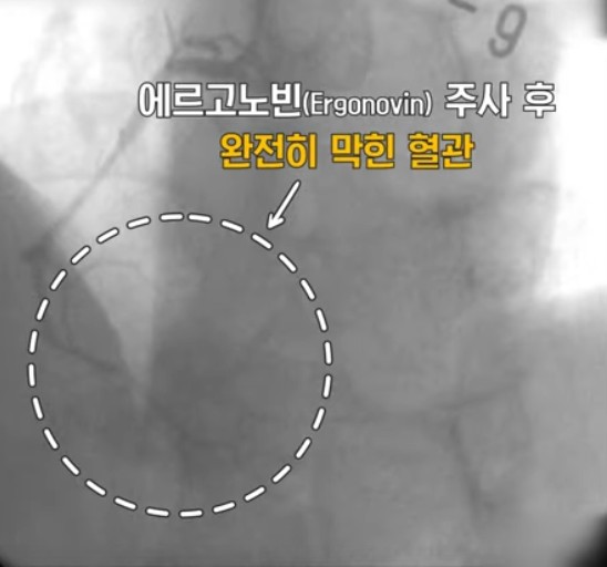 변이형협심증
