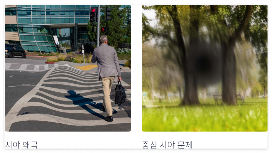 황반변성의 주요증상