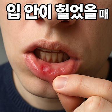 입안이 헐었을 때 영양소, 부드러운 음식, 자극적인 음식, 입안이 허는 이유와 치료 방법