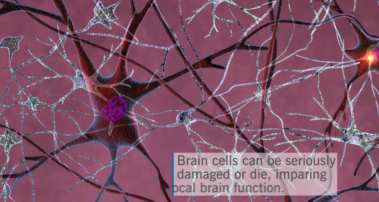 뇌경색 전조증상