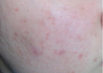 피부 건선 사진