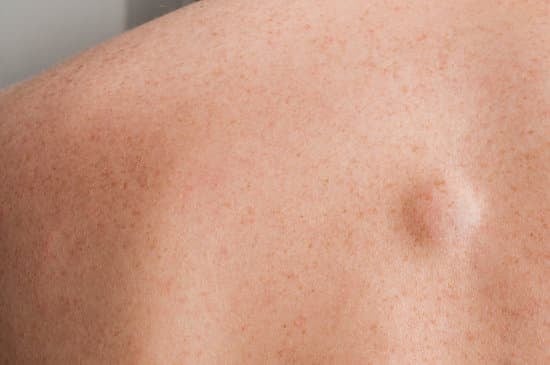 지방종 (Lipoma) ❘ 흔하지만 걱정되는 피하 종양