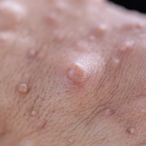 신경섬유종 초기 증상, 혹시 나도? 놓치면 안 되는 신호